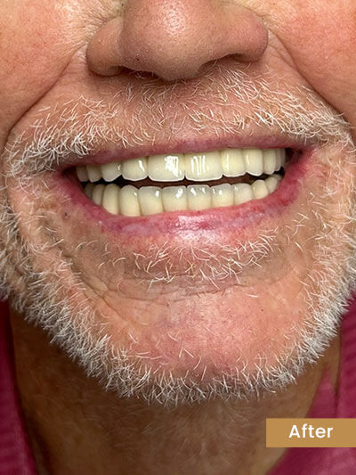 After treatment
